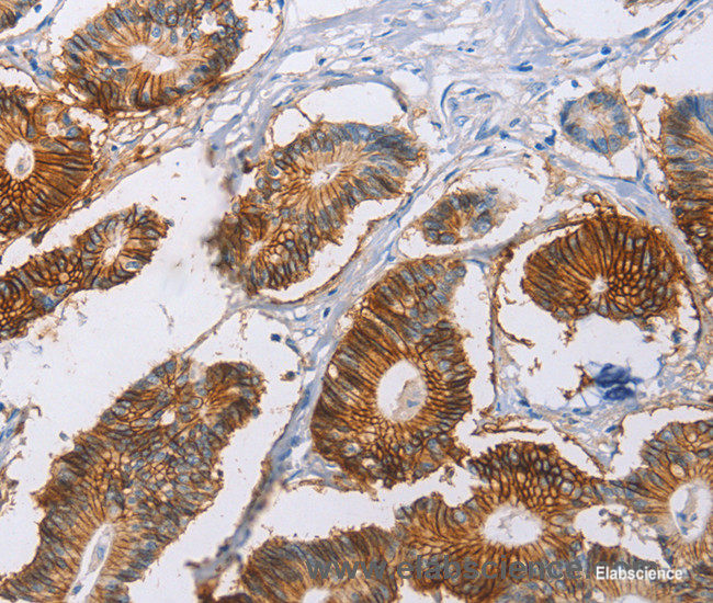 Immunohistochemistry of paraffin-embedded Human colon cancer tissue using CA9 Polyclonal Antibody at dilution 1:40