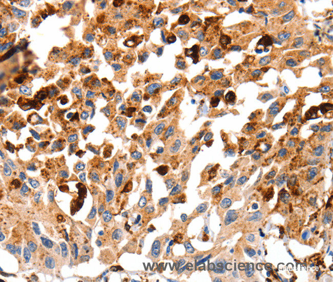 Immunohistochemistry of paraffin-embedded Human lung cancer tissue using Cathepsin B Polyclonal Antibody at dilution 1:35