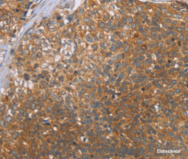 Immunohistochemistry of paraffin-embedded Human cervical cancer tissue using CCL21 Polyclonal Antibody at dilution 1:40
