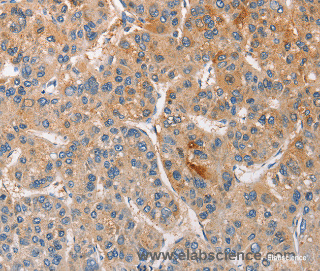 Immunohistochemistry of paraffin-embedded Human liver cancer tissue using CCL4 Polyclonal Antibody at dilution 1:40