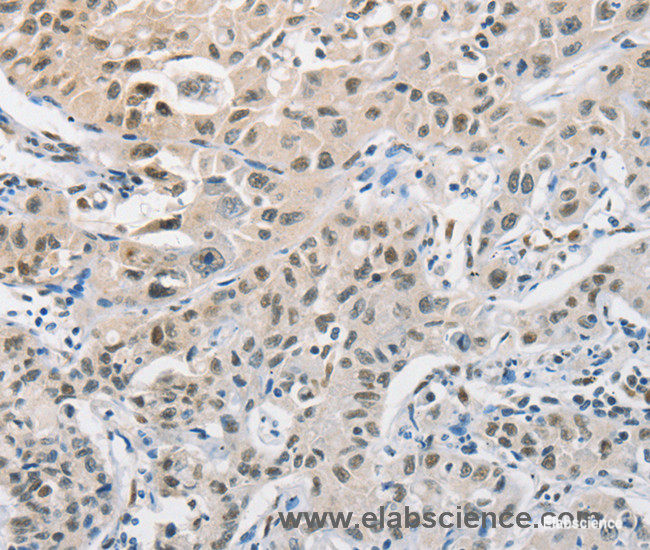 Immunohistochemistry of paraffin-embedded Human lung cancer tissue using CDC27 Polyclonal Antibody at dilution 1:50