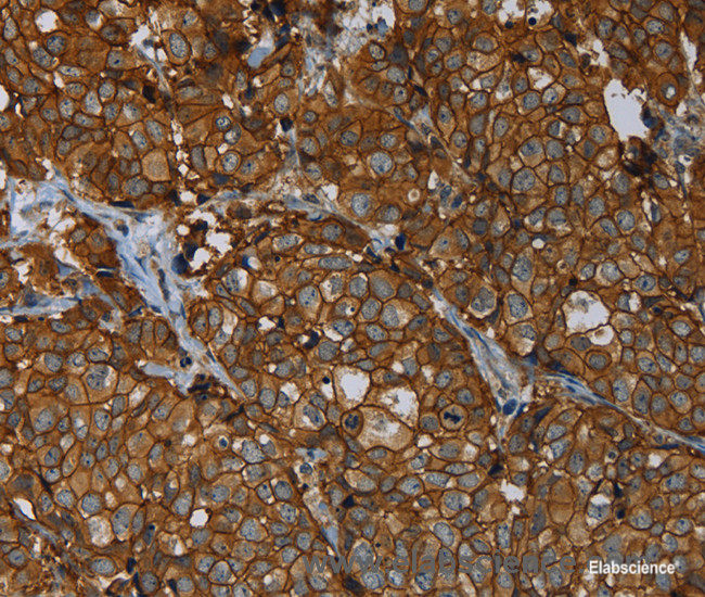 Immunohistochemistry of paraffin-embedded Human breast cancer tissue using ERBB4 Polyclonal Antibody at dilution 1:40