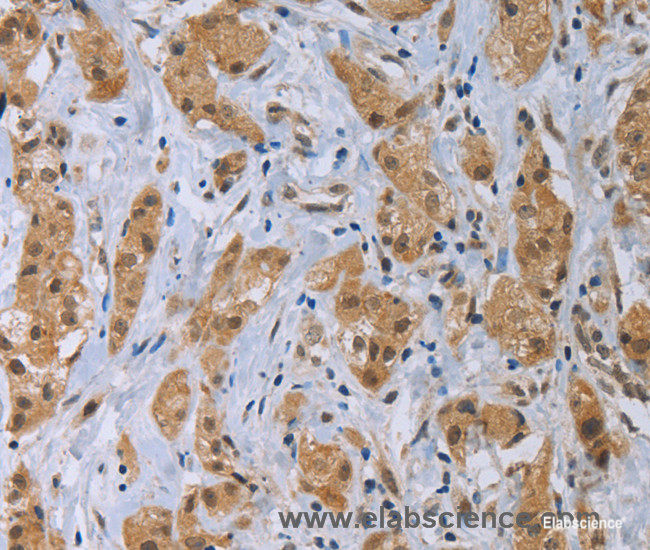 Immunohistochemistry of paraffin-embedded Human breast cancer tissue using CLEC1A Polyclonal Antibody at dilution 1:40