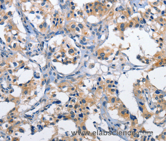 Immunohistochemistry of paraffin-embedded Human thyroid cancer tissue using CLEC2D Polyclonal Antibody at dilution 1:60