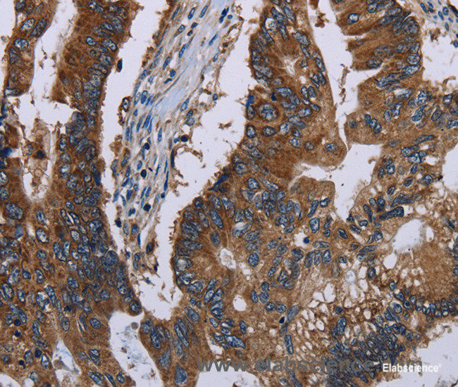 Immunohistochemistry of paraffin-embedded Human colon cancer tissue using CLDND1 Polyclonal Antibody at dilution 1:40