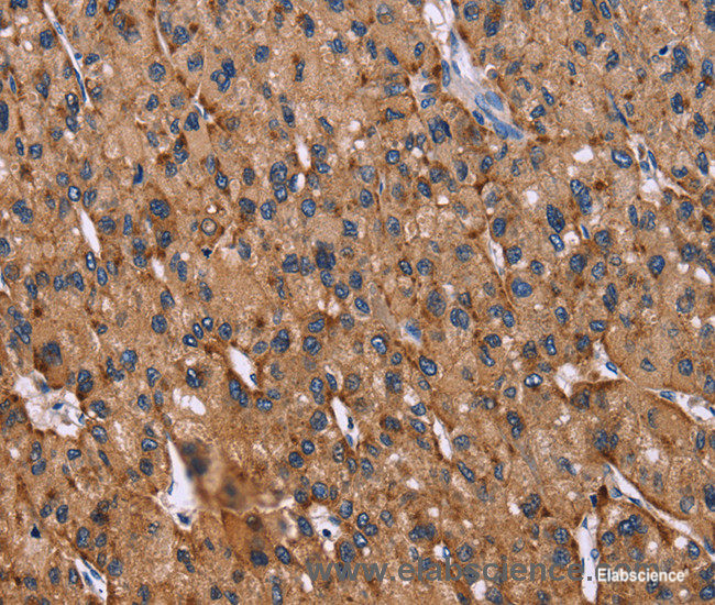 Immunohistochemistry of paraffin-embedded Human liver cancer tissue using CD107b Polyclonal Antibody at dilution 1:30