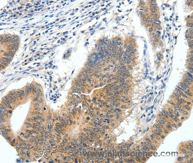 Immunohistochemistry of paraffin-embedded Human colon cancer tissue using ECE2 Polyclonal Antibody at dilution 1:40