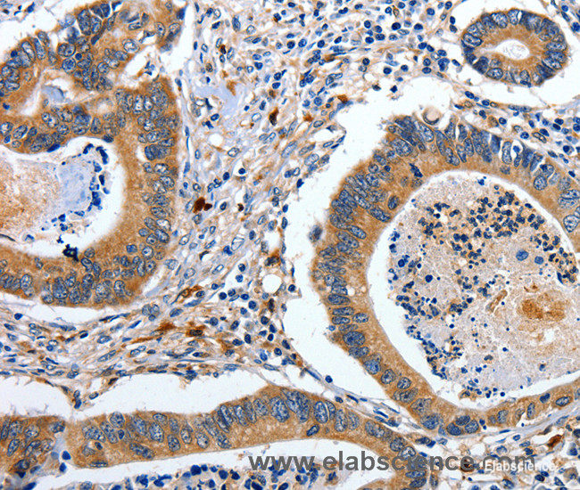 Immunohistochemistry of paraffin-embedded Human colon cancer tissue using EFNB2 Polyclonal Antibody at dilution 1:80