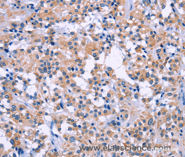 Immunohistochemistry of paraffin-embedded Human thyroid cancer tissue using DUSP22 Polyclonal Antibody at dilution 1:60