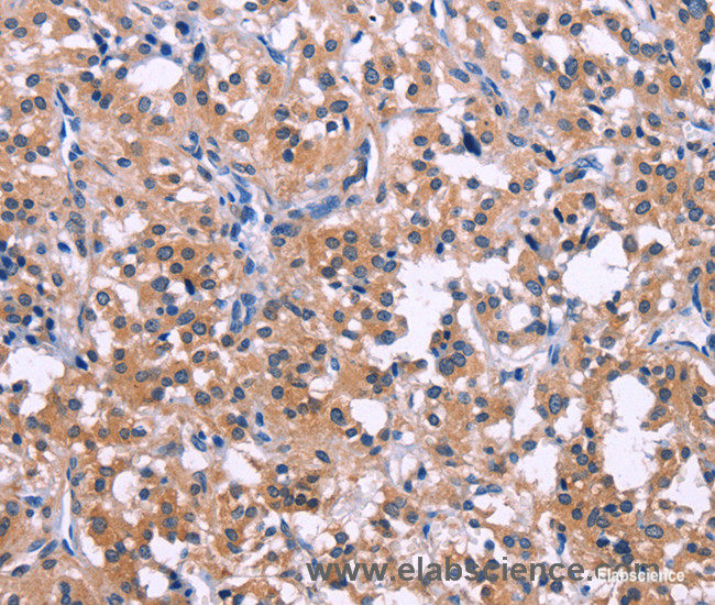 Immunohistochemistry of paraffin-embedded Human thyroid cancer tissue using DUSP13 Polyclonal Antibody at dilution 1:50