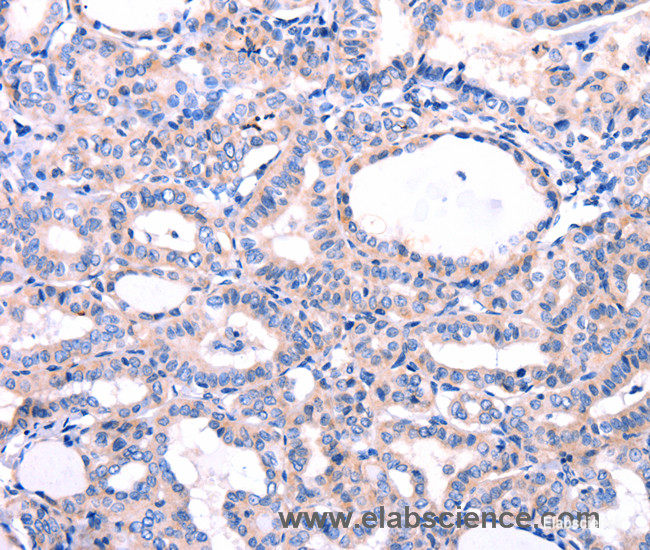 Immunohistochemistry of paraffin-embedded Human thyroid cancer tissue using DUSP12 Polyclonal Antibody at dilution 1:77