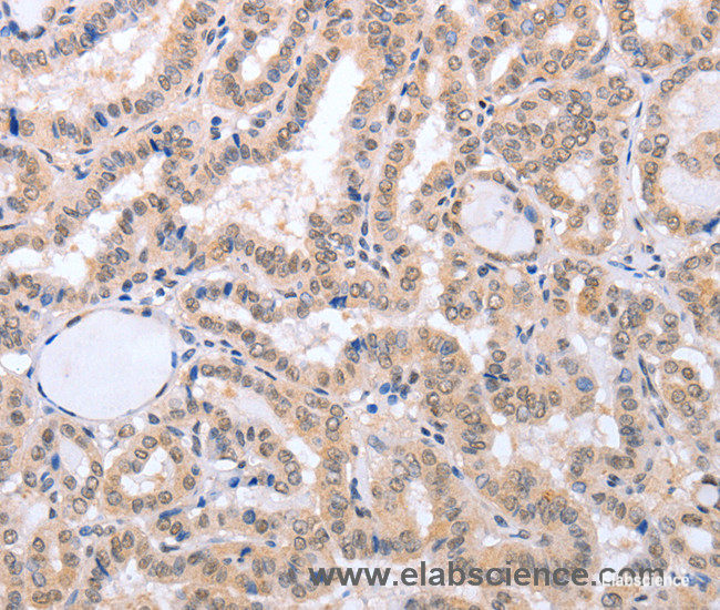 Immunohistochemistry of paraffin-embedded Human thyroid cancer tissue using FADD Polyclonal Antibody at dilution 1:50