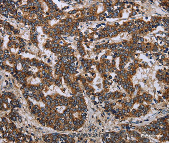 Immunohistochemistry of paraffin-embedded Human liver cancer tissue using LGALS2 Polyclonal Antibody at dilution 1:30