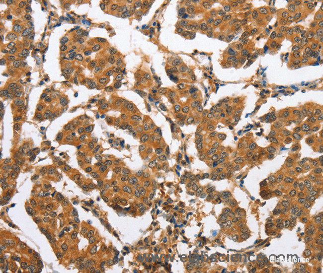Immunohistochemistry of paraffin-embedded Human breast cancer tissue using CXCL14 Polyclonal Antibody at dilution 1:60