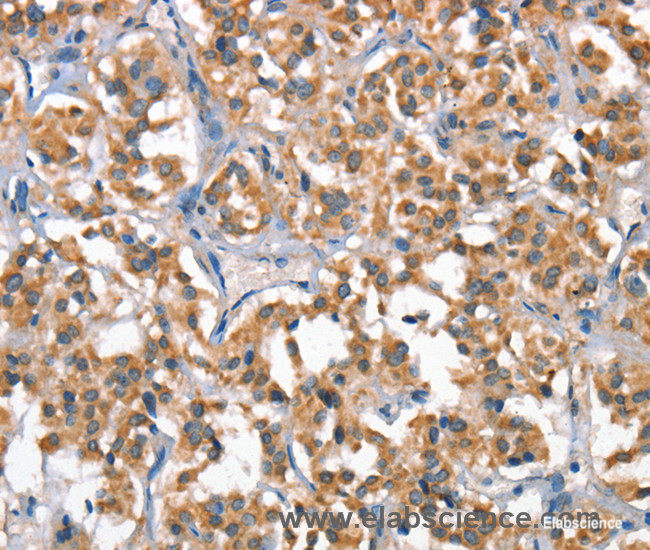 Immunohistochemistry of paraffin-embedded Human thyroid cancer tissue using HGF Polyclonal Antibody at dilution 1:65