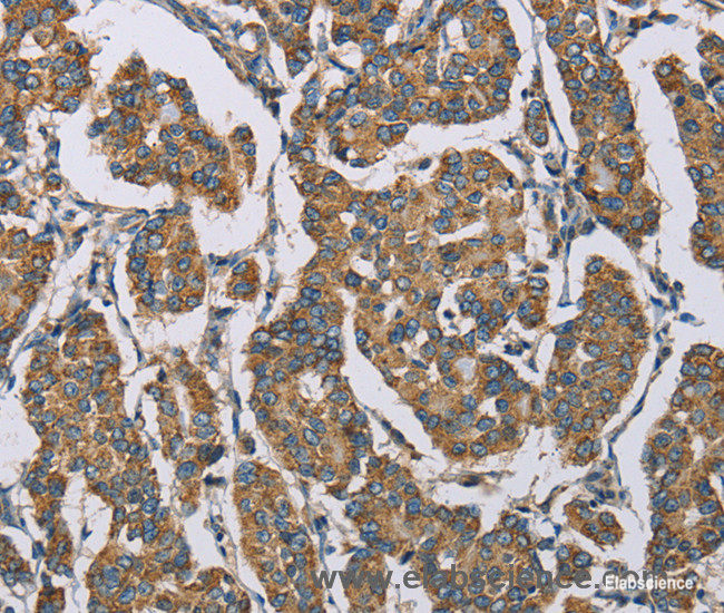 Immunohistochemistry of paraffin-embedded Human breast cancer tissue using HDAC6 Polyclonal Antibody at dilution 1:50
