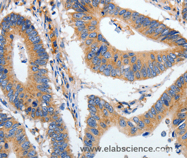 Immunohistochemistry of paraffin-embedded Human colon cancer tissue using HSPA1A Polyclonal Antibody at dilution 1:40