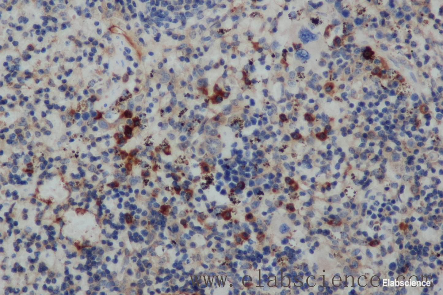 Immunohistochemistry of paraffin-embedded Human cervical cancer tissue using IFNG Polyclonal Antibody at dilution 1:30