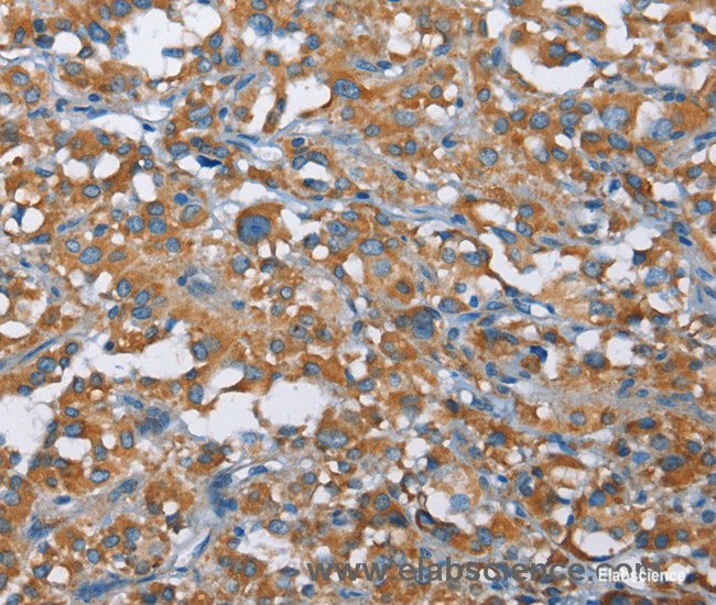 Immunohistochemistry of paraffin-embedded Human thyroid cancer tissue using KLF7 Polyclonal Antibody at dilution 1:40