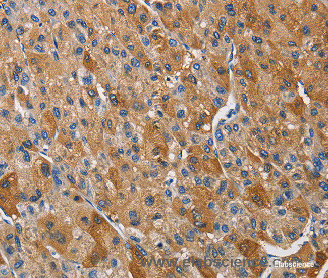 Immunohistochemistry of paraffin-embedded Human liver cancer tissue using KLK1 Polyclonal Antibody at dilution 1:40