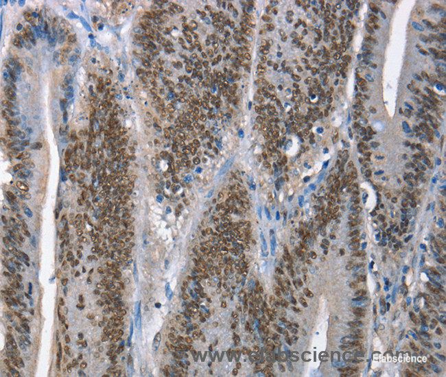 Immunohistochemistry of paraffin-embedded Human colon cancer tissue using GNRH1 Polyclonal Antibody at dilution 1:65