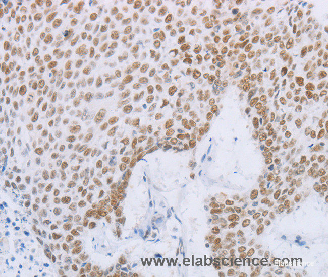 Immunohistochemistry of paraffin-embedded Human lung cancer tissue using MCM2 Polyclonal Antibody at dilution 1:50