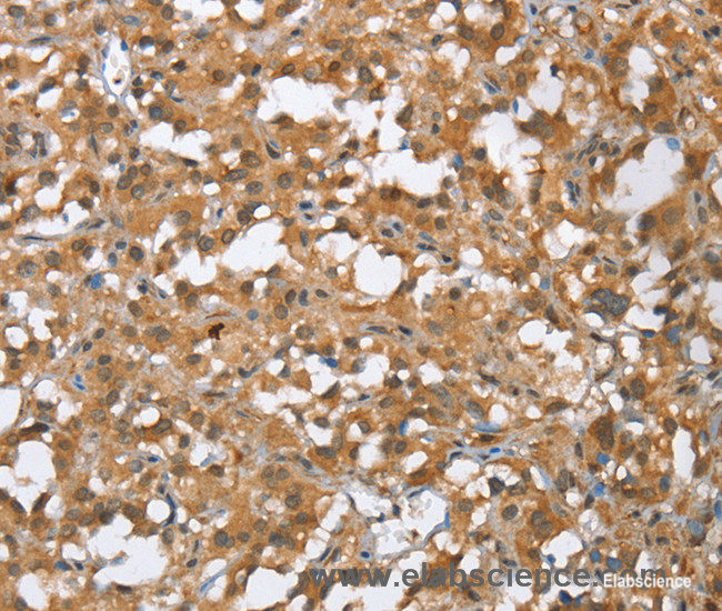 Immunohistochemistry of paraffin-embedded Human thyroid cancer tissue using MMP12 Polyclonal Antibody at dilution of 1:60