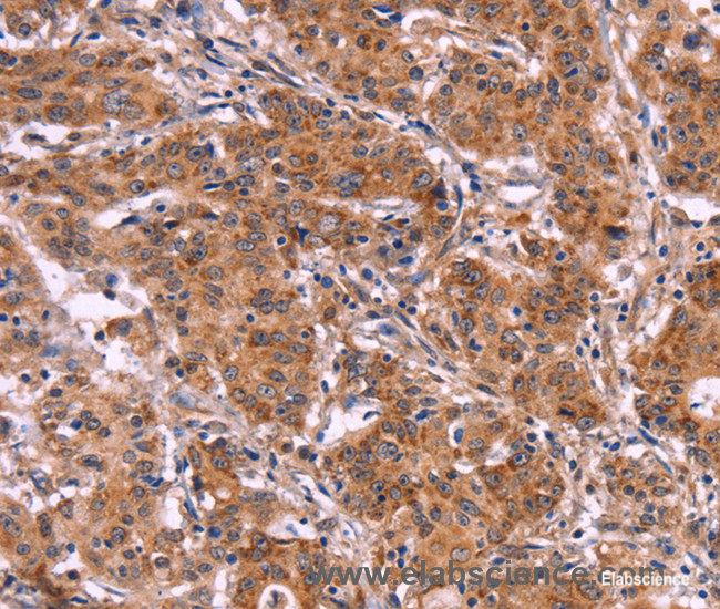 Immunohistochemistry of paraffin-embedded Human gasrtic cancer tissue using MMP14 Polyclonal Antibody at dilution 1:40