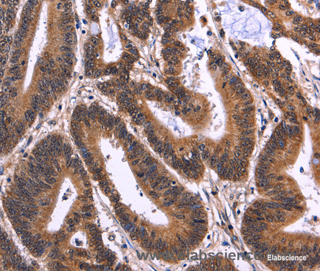 Immunohistochemistry of paraffin-embedded Human colon cancer tissue using MSH4 Polyclonal Antibody at dilution 1:50