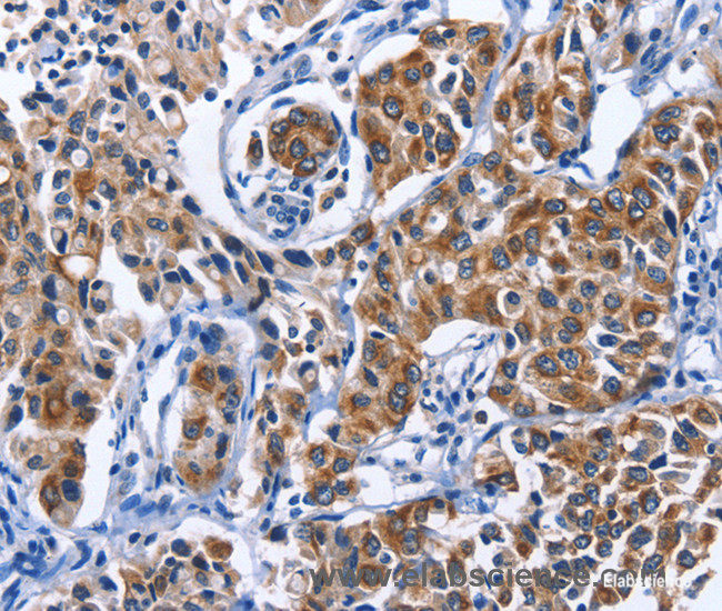 Immunohistochemistry of paraffin-embedded Human lung cancer tissue using MYH1 Polyclonal Antibody at dilution 1:40