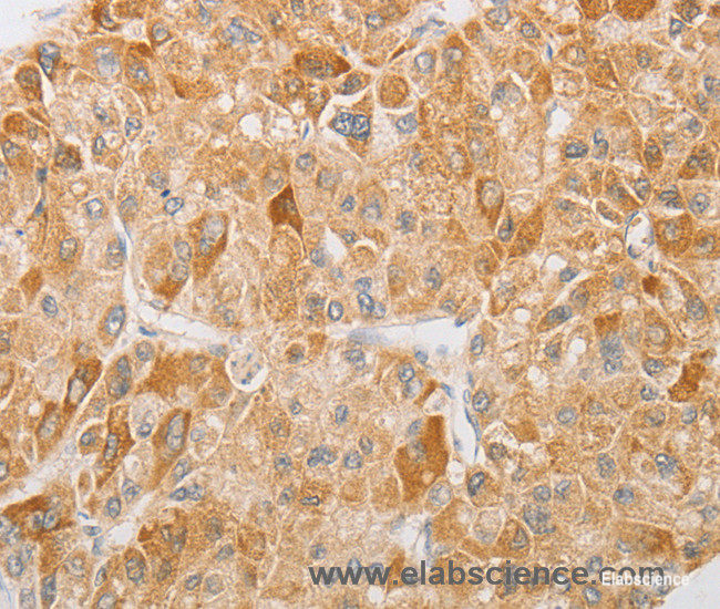 Immunohistochemistry of paraffin-embedded Human liver cancer tissue using NGF Polyclonal Antibody at dilution 1:40