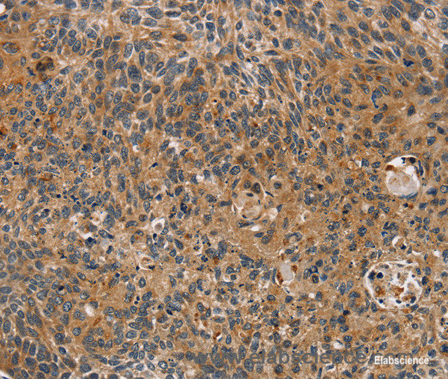 Immunohistochemistry of paraffin-embedded Human esophagus cancer tissue using TAC1 Polyclonal Antibody at dilution 1:25
