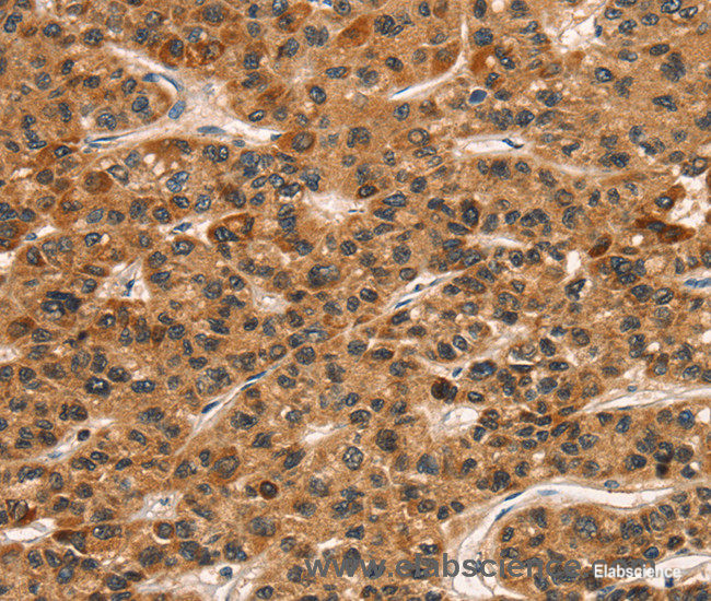 Immunohistochemistry of paraffin-embedded Human liver cancer tissue using CD159a/c Polyclonal Antibody at dilution 1:30
