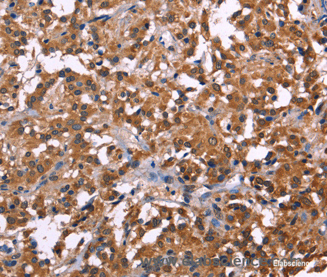 Immunohistochemistry of paraffin-embedded Human thyroid cancer tissue using NOS2 Polyclonal Antibody at dilution 1:30