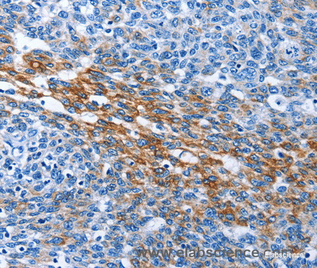 Immunohistochemistry of paraffin-embedded Human ovarian cancer tissue using PAK6 Polyclonal Antibody at dilution 1:40