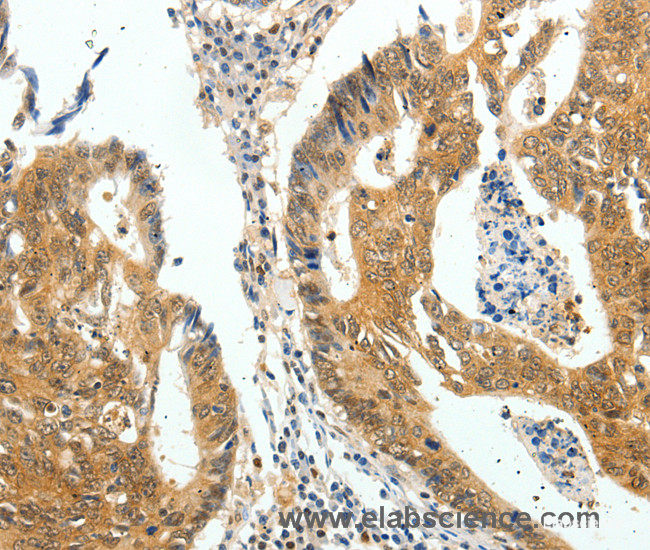 Immunohistochemistry of paraffin-embedded Human colon cancer tissue using Otocadherin Polyclonal Antibody at dilution 1:60