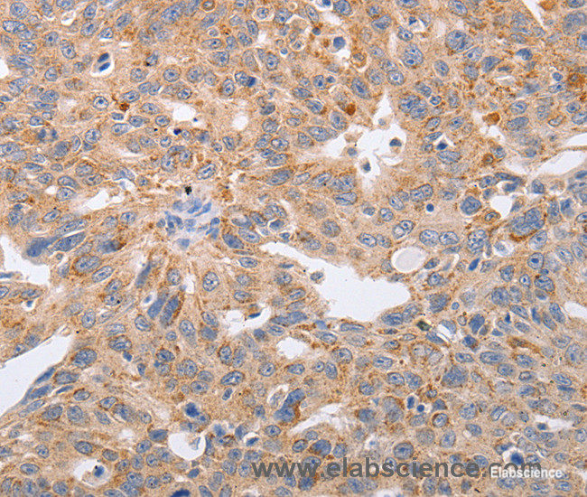 Immunohistochemistry of paraffin-embedded Human ovarian cancer tissue using PPP1CB Polyclonal Antibody at dilution 1:40