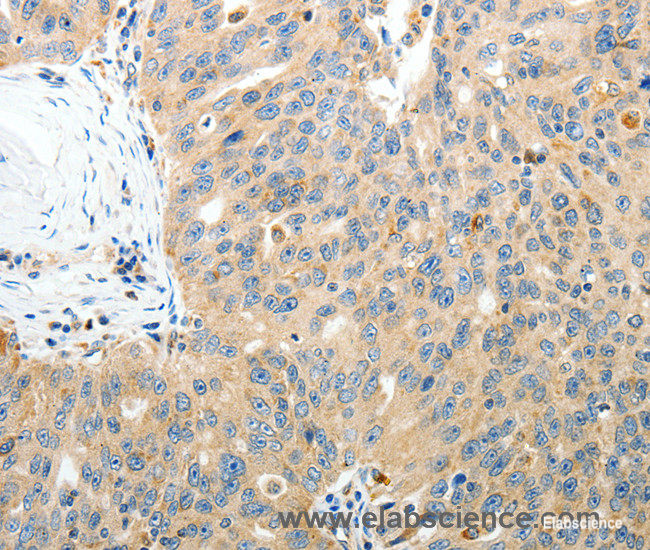 Immunohistochemistry of paraffin-embedded Human ovarian cancer tissue using RAMP3 Polyclonal Antibody at dilution 1:40