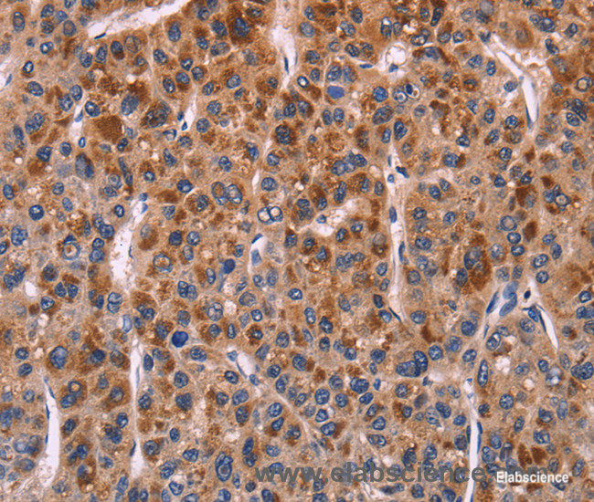 Immunohistochemistry of paraffin-embedded Human liver cancer tissue using SELPLG Polyclonal Antibody at dilution 1:50