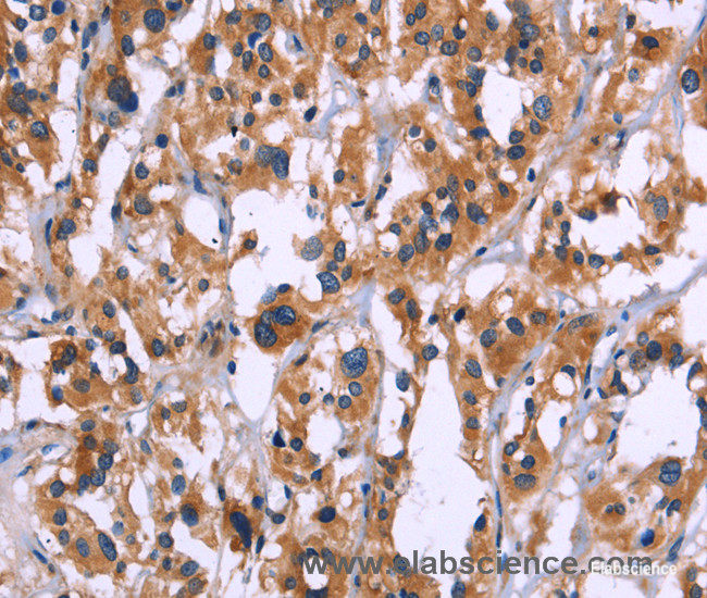 Immunohistochemistry of paraffin-embedded Human thyroid cancer tissue using ZEB2 Polyclonal Antibody at dilution 1:60