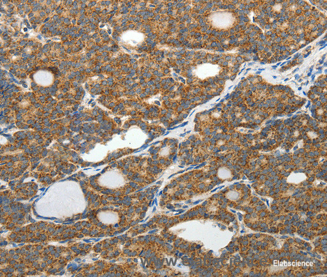 Immunohistochemistry of paraffin-embedded Human thyroid cancer tissue using SLC12A4 Polyclonal Antibody at dilution 1:30