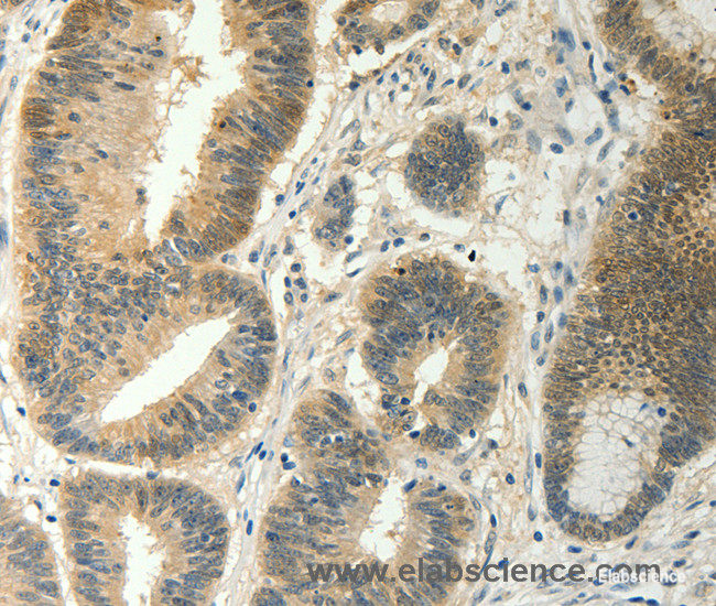 Immunohistochemistry of paraffin-embedded Human colon cancer tissue using SOCS5 Polyclonal Antibody at dilution 1:35