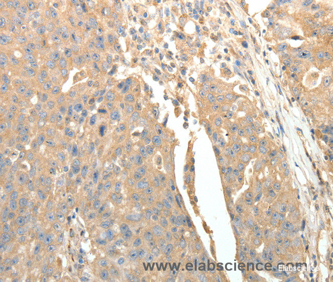 Immunohistochemistry of paraffin-embedded Human ovarian cancer tissue using SFTPD Polyclonal Antibody at dilution 1:30