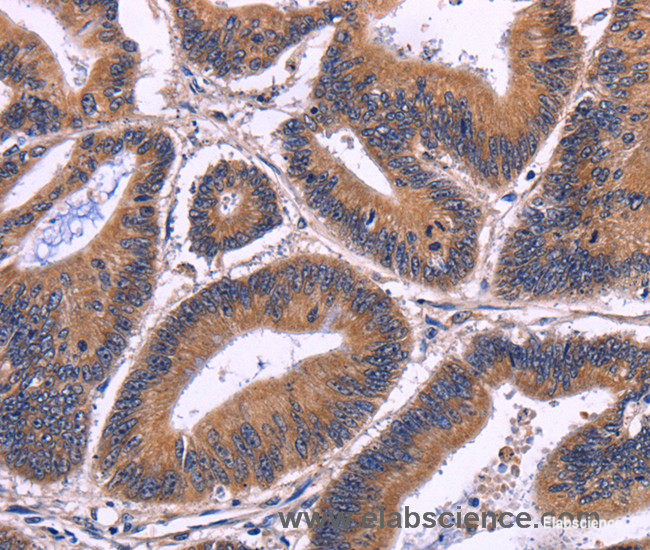 Immunohistochemistry of paraffin-embedded Human colon cancer tissue using SPATA7 Polyclonal Antibody at dilution 1:30