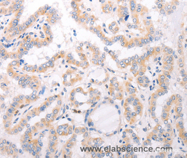 Immunohistochemistry of paraffin-embedded Human thyroid cancer tissue using CIDEB Polyclonal Antibody at dilution 1:50