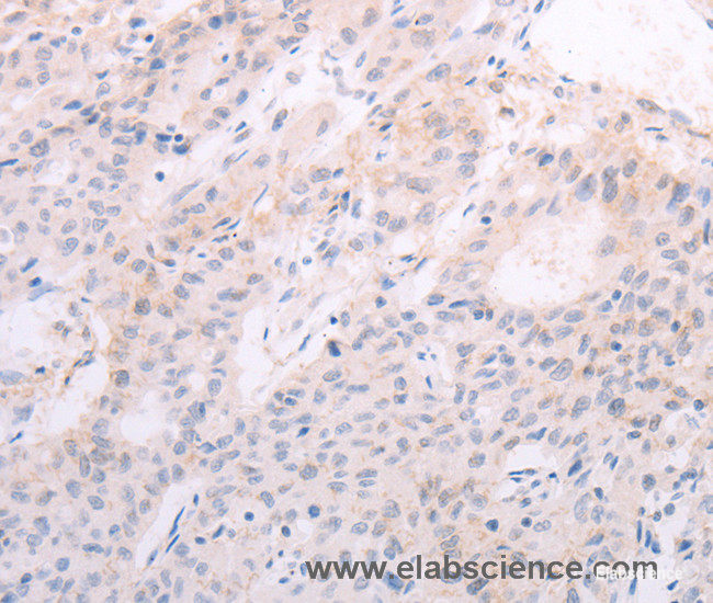 Immunohistochemistry of paraffin-embedded Human liver cancer tissue using TSHR Polyclonal Antibody at dilution 1:50
