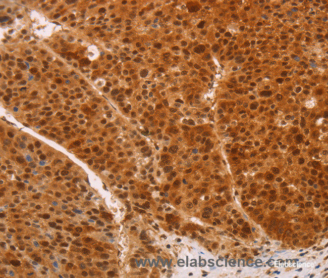 Immunohistochemistry of paraffin-embedded Human liver cancer tissue using HEXIM1 Polyclonal Antibody at dilution 1:65