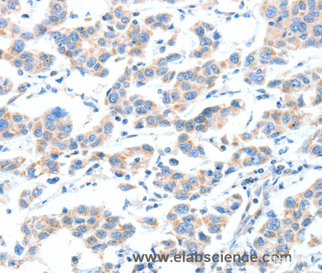 Immunohistochemistry of paraffin-embedded Human breast cancer tissue using XBP1 Polyclonal Antibody at dilution 1:70