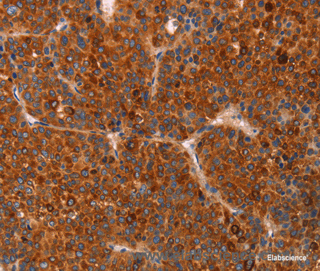 Immunohistochemistry of paraffin-embedded Human liver cancer tissue using GC Polyclonal Antibody at dilution 1:30