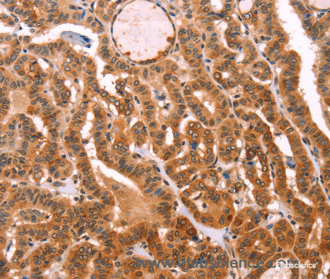 Immunohistochemistry of paraffin-embedded Human thyroid cancer tissue using PROS1 Polyclonal Antibody at dilution 1:40
